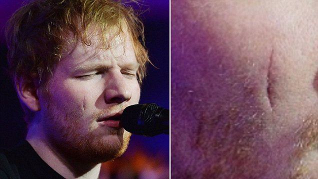 26. Ed Sheeran - cheek scar. 